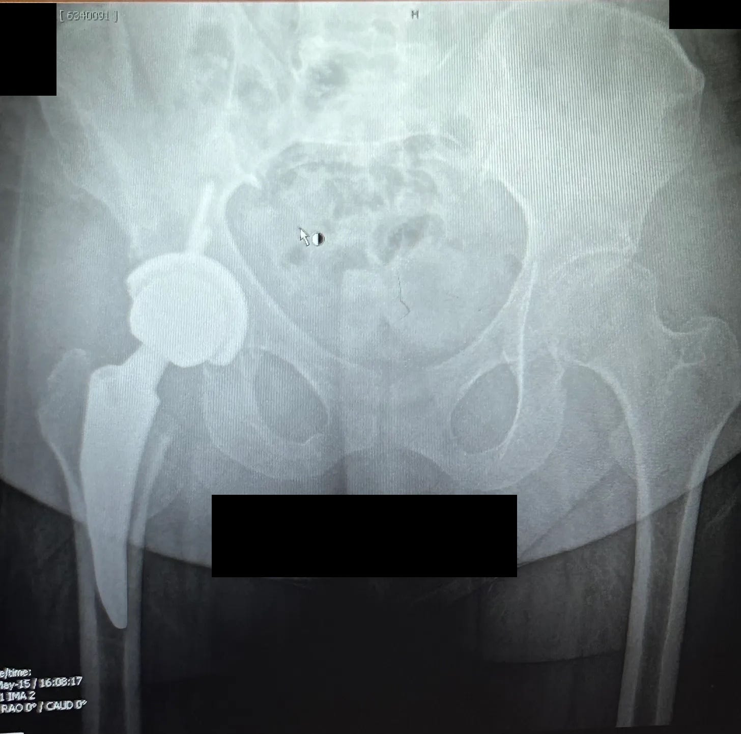Artificial hip visible in my six-month post-op X-ray.