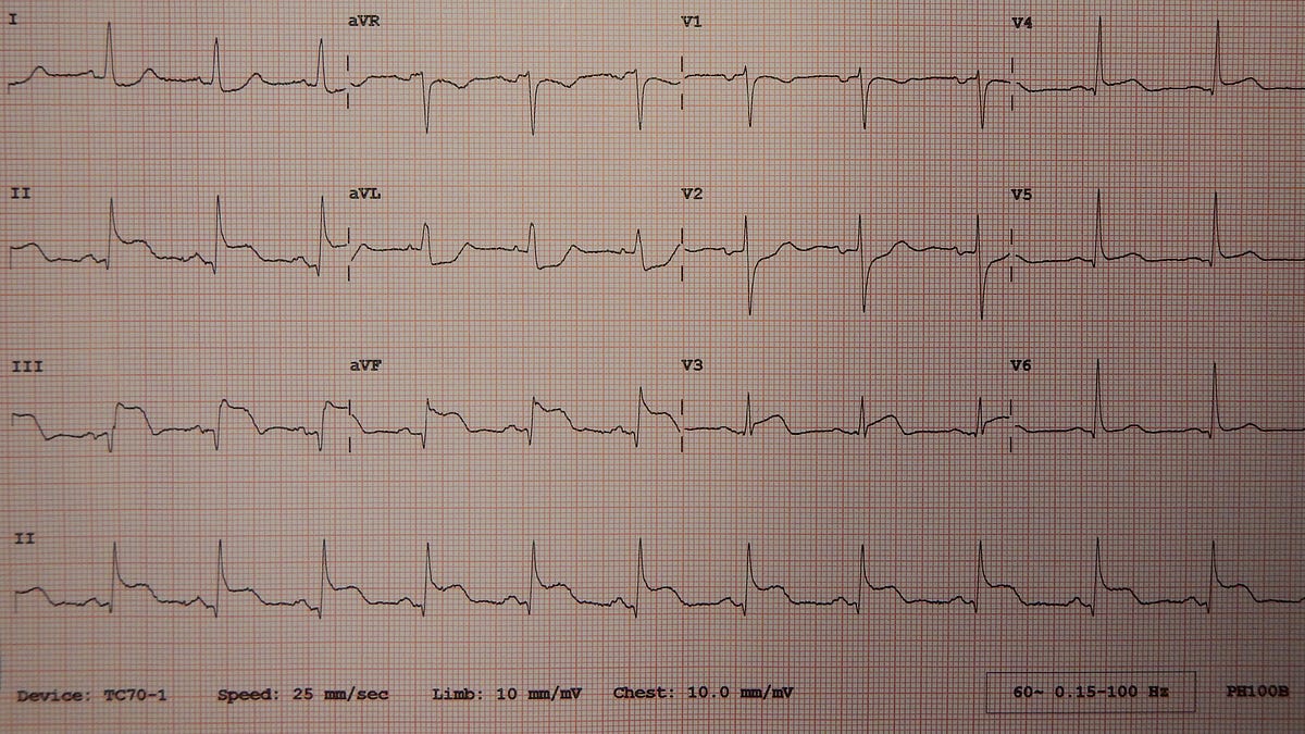 Hidden dangers of inferior STEMI - by Ioannis Protonotarios