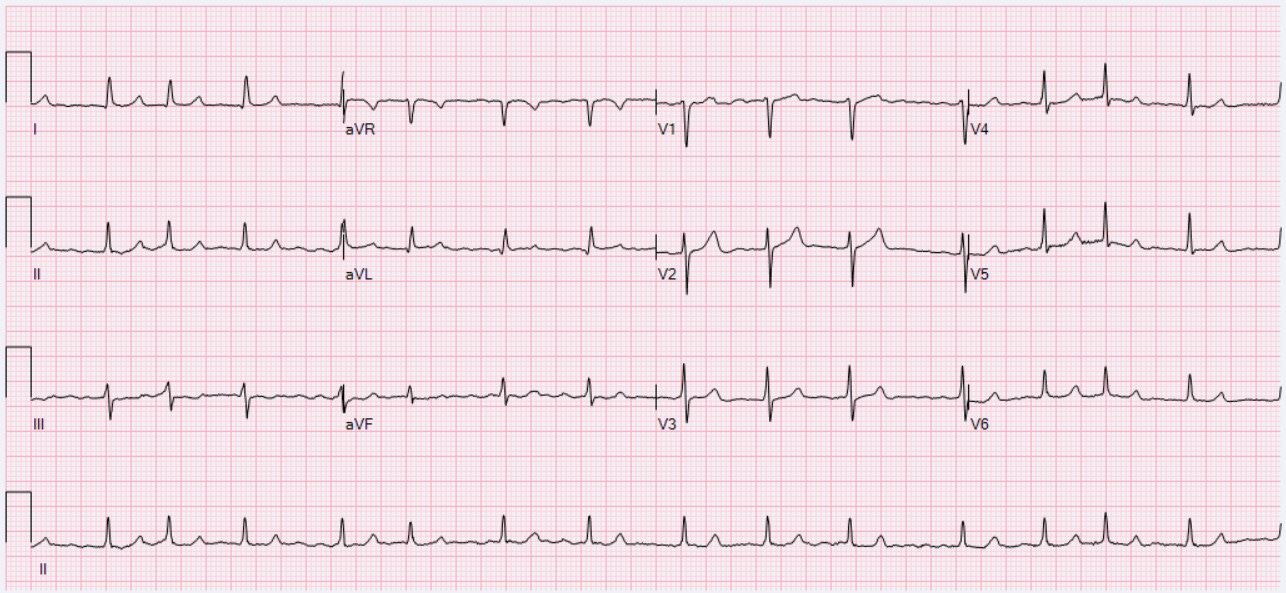 https://upload.wikimedia.org/wikipedia/commons/4/43/ECG_Atrial_Fibrillation_90_bpm.jpg