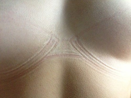 [ image: marques rouges du soutien-gorge ]