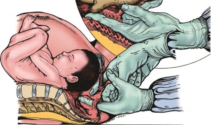 Traditional Obstetric Pelvimetry in Delivery and Labor | SpringerLink