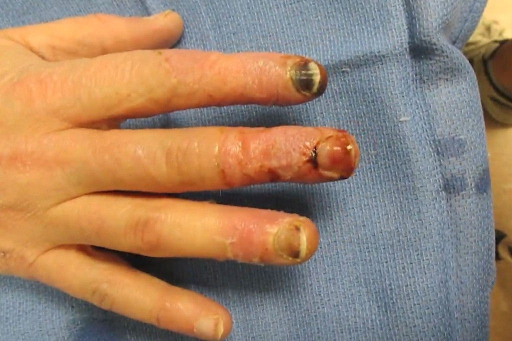 The fan's fingers later turned into dark blue and purple colors.