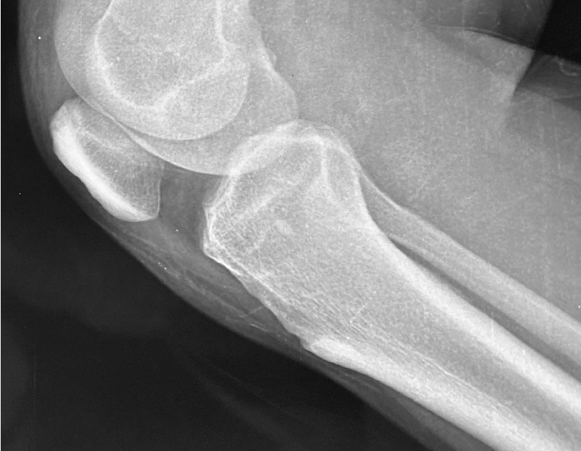 Case 4: Intra-Capsular Popliteal Fossa Mass