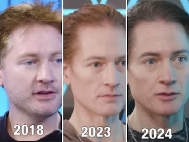 Tech Billionaire Bryan Johnson's Anti-ageing Transformation Pictures Are  Unbelievable - News18
