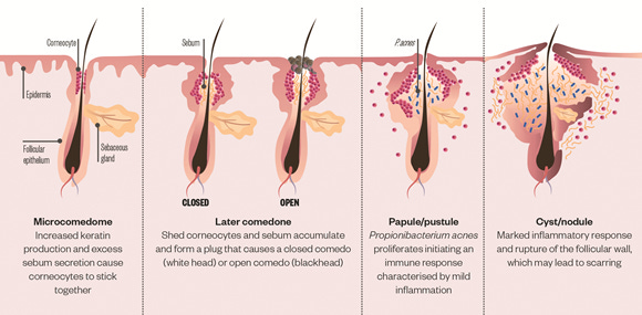 Acne Vulgaris: Do You Know Your Comedones? | BROWN MED-PEDS
