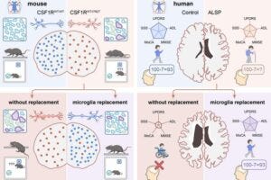 In ALSP, replacing microglia—via gene-corrected bone marrow in mice or targeted transplant in humans—restores brain health and prevents motor and cognitive decline.