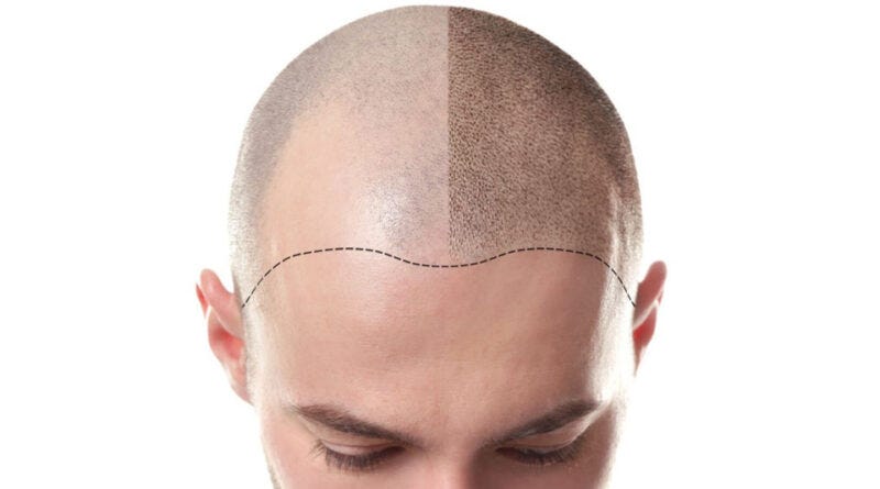 baldness
