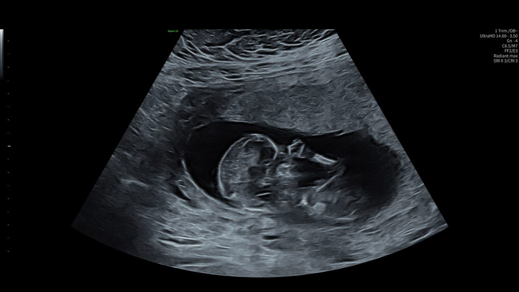 An ultrasound of a fetus

AI-generated content may be incorrect.