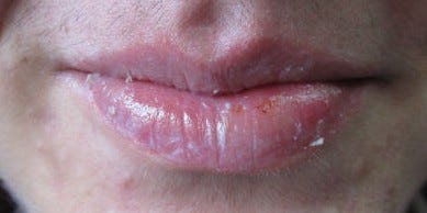 Most common side effects of isotretinoin (“accutane”) for the treatment of acne - Dra. LOREA BAGAZGOITIA Most common side effects of isotretinoin (“accutane”) for the treatment of acne - Dra. LOREA BAGAZGOITIA