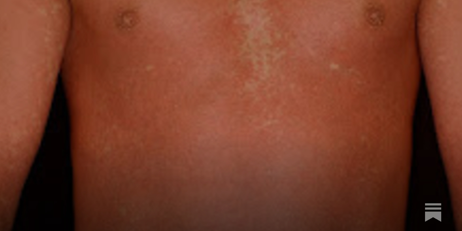 Amoxicillin Rash: Pictures, How to Identify and Treat, image size:1600x800