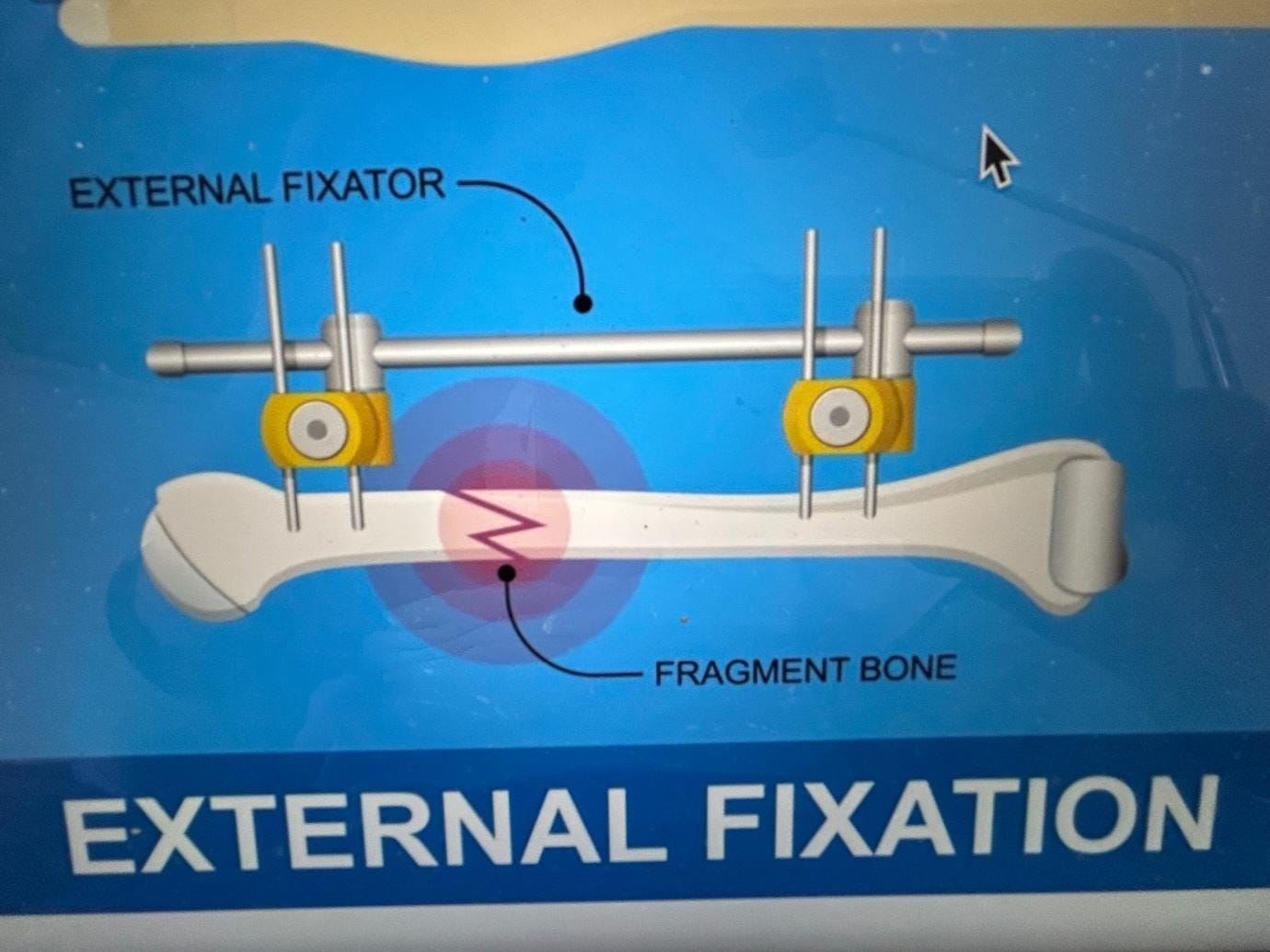 A diagram of a bone

AI-generated content may be incorrect.