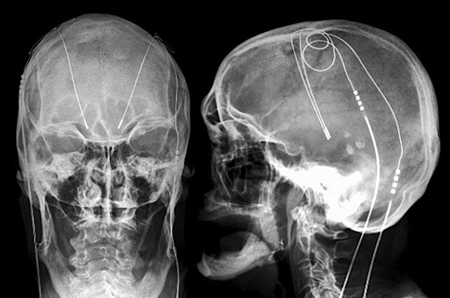 Deep brain stimulators - Questions and Answers ​in MRI