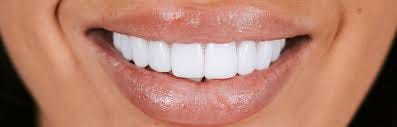 Dental Veneers - Everything You Need to ...