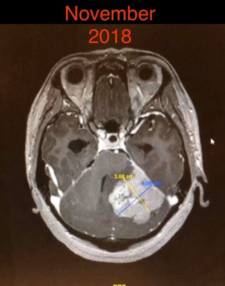 A brain scan showing the size and location of the tumour A brain scan showing the size and location of the tumour