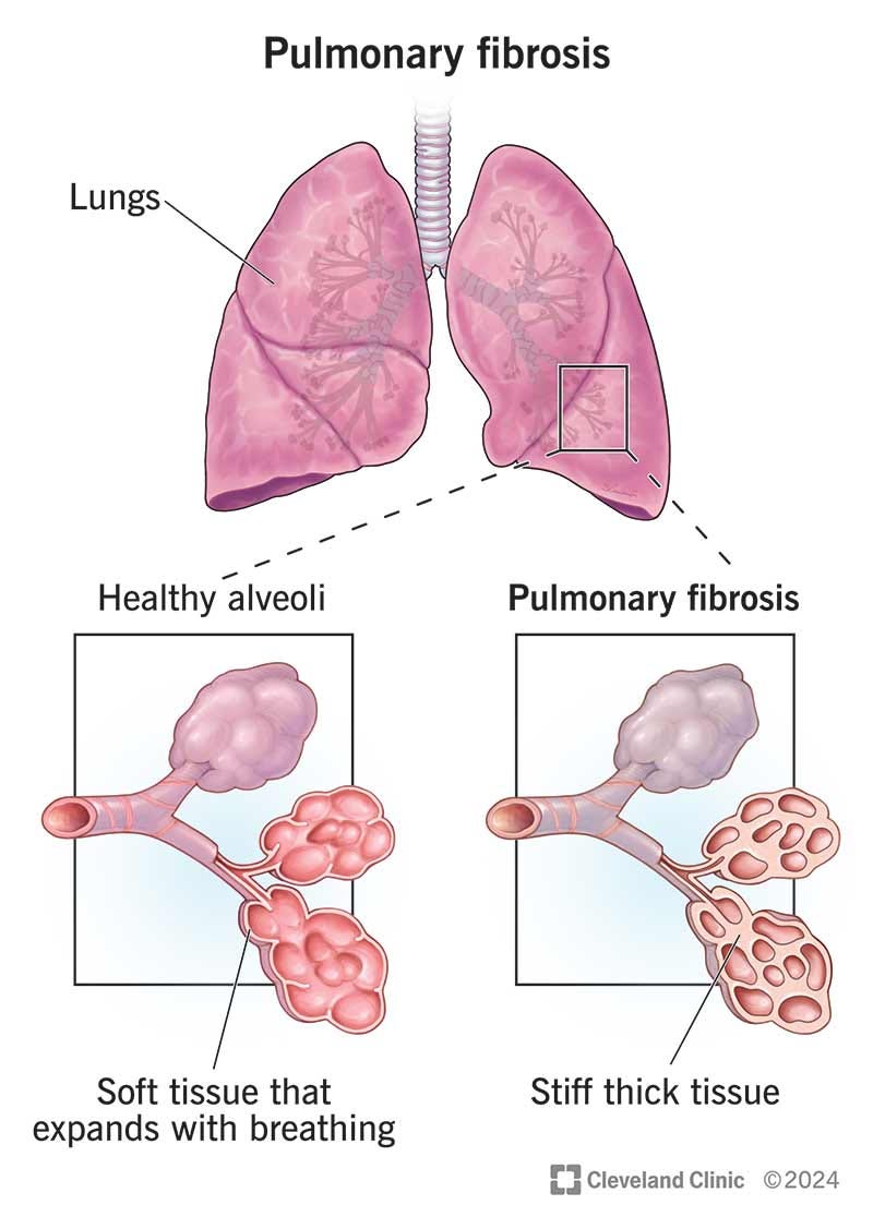 Pulmonary Fibrosis: Causes, Symptoms & Treatment