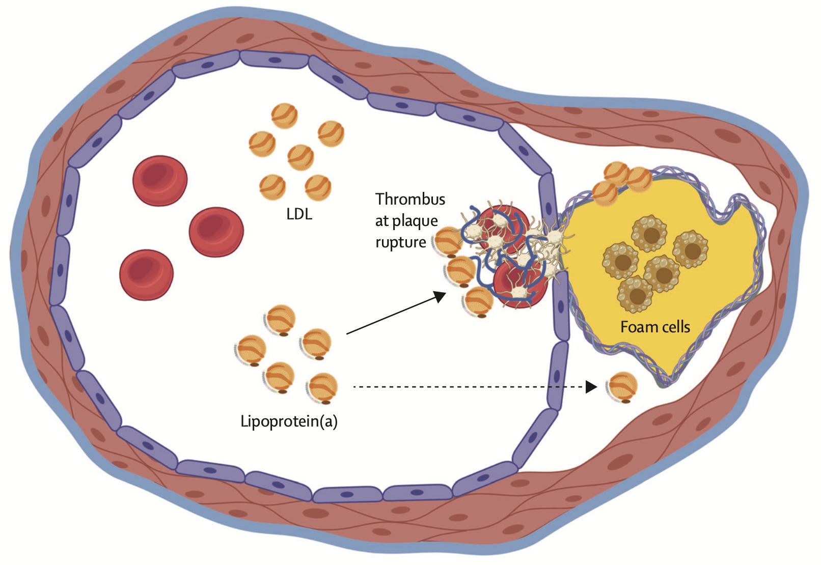 Lp Risk Complications Lp(a) Explained: Genetics, Risk, and What You Can Actually Do