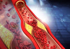 Atherosclerosis -