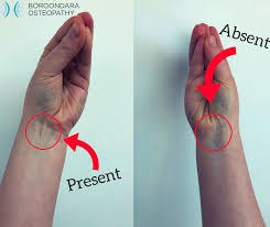 Boroondara Osteopathy - A "HANDY" FACT TO KNOW 👌👍👋 Do you have the Palmaris  Longus Muscle?? 🤔🤔 The Palmaris Longus muscle is 1 of the 8 muscles that  make up the inside