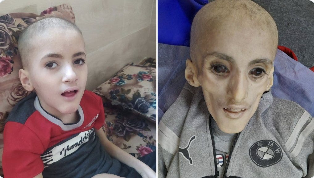 The Pakistan Frontier on X: "Shocking pictures of the body of the Palestinian child Yazan Al-Kafarna who passed away this morning due to the deterioration of his health condition because of no