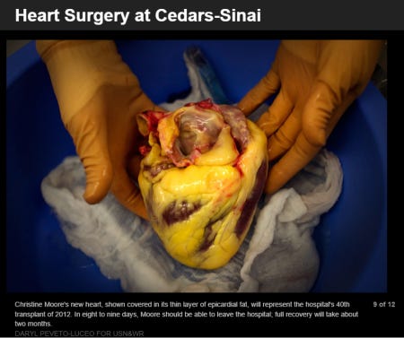 The same picture of a human heart as above, this time with the original and correct text: "Christine Moore's new heart, shown covered in its thin layer of epicardial fat, will represent the hospital's 40th transplant of 2012. In eight to nine days, Moore should be able to leave the hospital, full recovery will take about two months. The same picture of a human heart as above, this time with the original and correct text: "Christine Moore's new heart, shown covered in its thin layer of epicardial fat, will represent the hospital's 40th transplant of 2012. In eight to nine days, Moore should be able to leave the hospital, full recovery will take about two months.