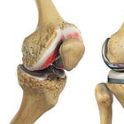 Total Knee Arthroplasty