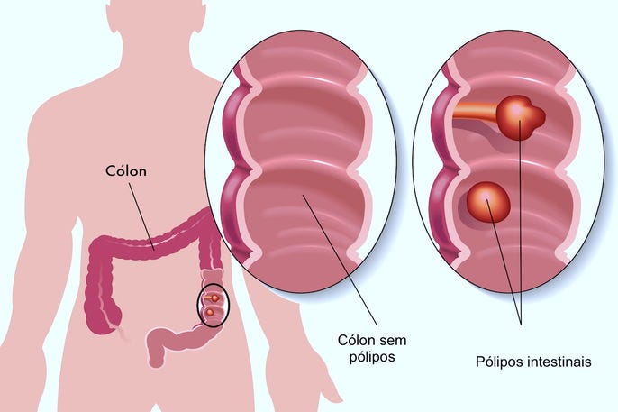 Como é feita a retirada dos pólipos intestinais