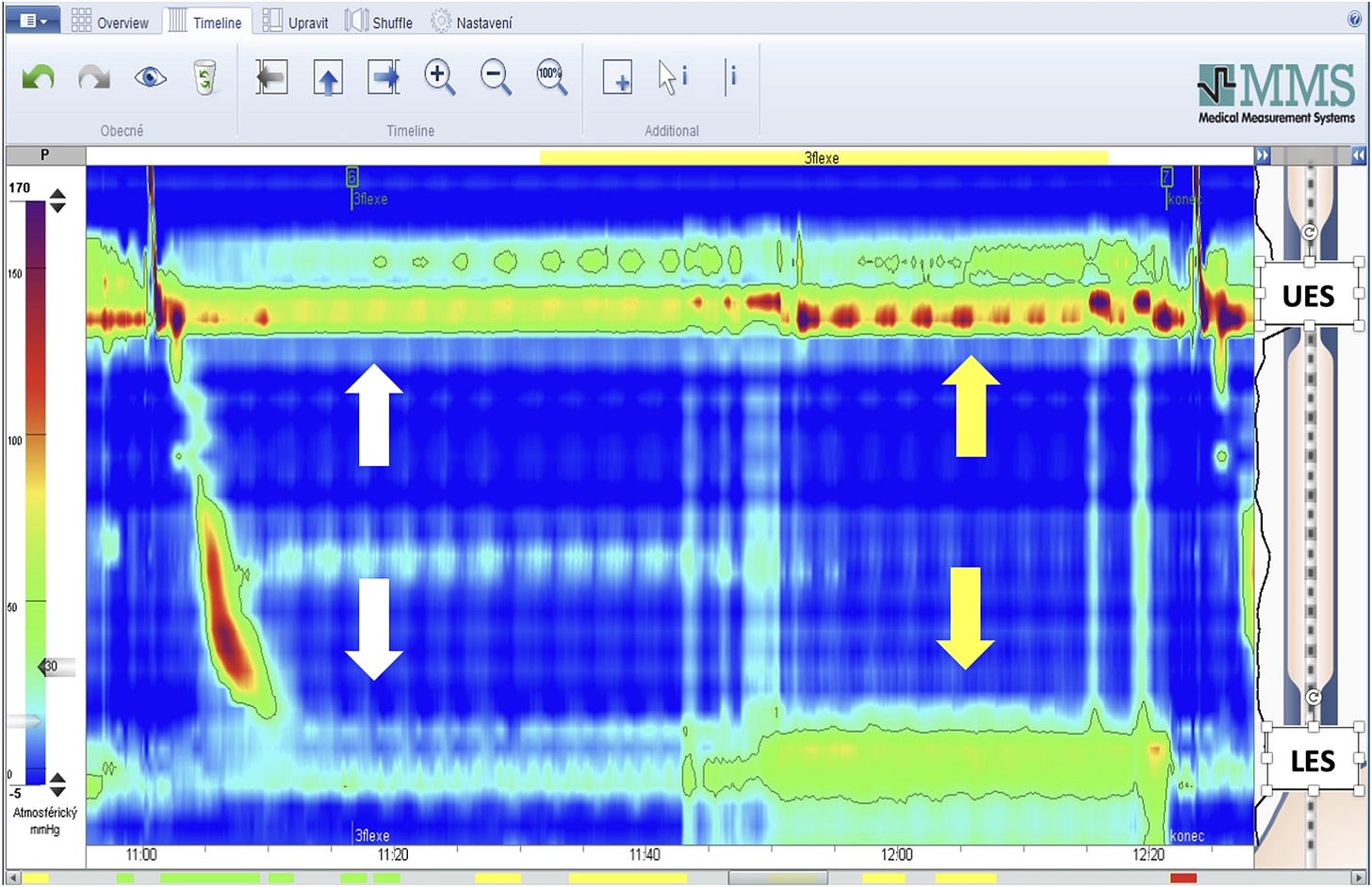 Bản ghi áp lực thực quản đo bằng manometry độ phân giải cao trong nghiệm pháp nâng chân thẳng, thể hiện mức tăng áp lực dùng để dự báo phơi nhiễm acid bất thường.