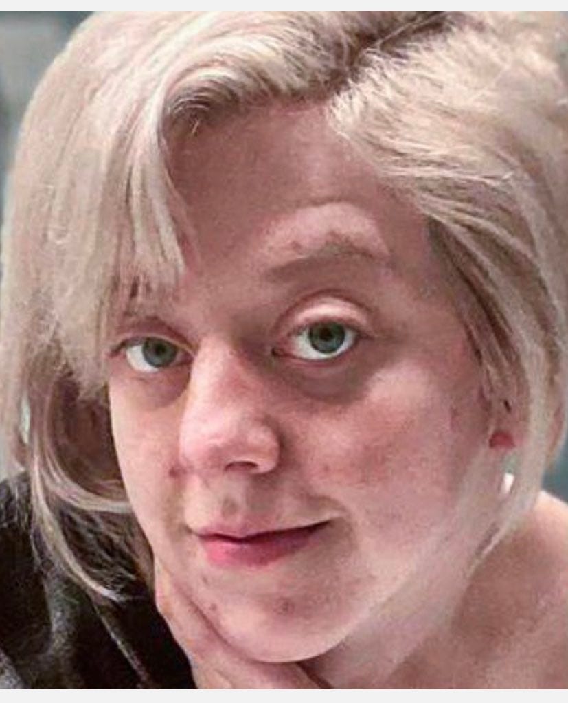 A close of up of Melissa’s face. She is blonde hair and blue eyed. A blue filter has been added, along with several blemishes, and dark circles under her eyes.