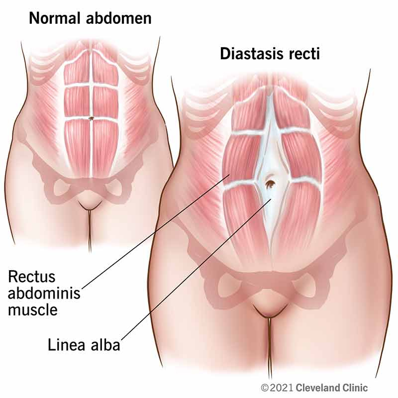 Normal abdomen compared to abdomen with diastasis recti