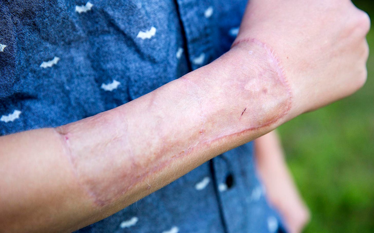 Boston Children's Hospital Constructs Penis For Transgender Man — A First  In Mass. | WBUR News