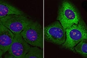 Accumulation of "junk proteins": normal cells (left) and cells subjected to the effect of the toxic arginine-rich protein (right). In the latter, ribosomal proteins (green fluorescent) and the size of nucleoli (red) are increased.