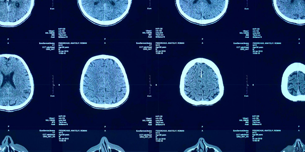 COVID-Vaccinated 4x's More Likely to Have Neurological Symptoms: 'Increased Risk of Functional Neurological Disorders Following SARS-CoV-2 Vaccination' (European Journal of Neurology)