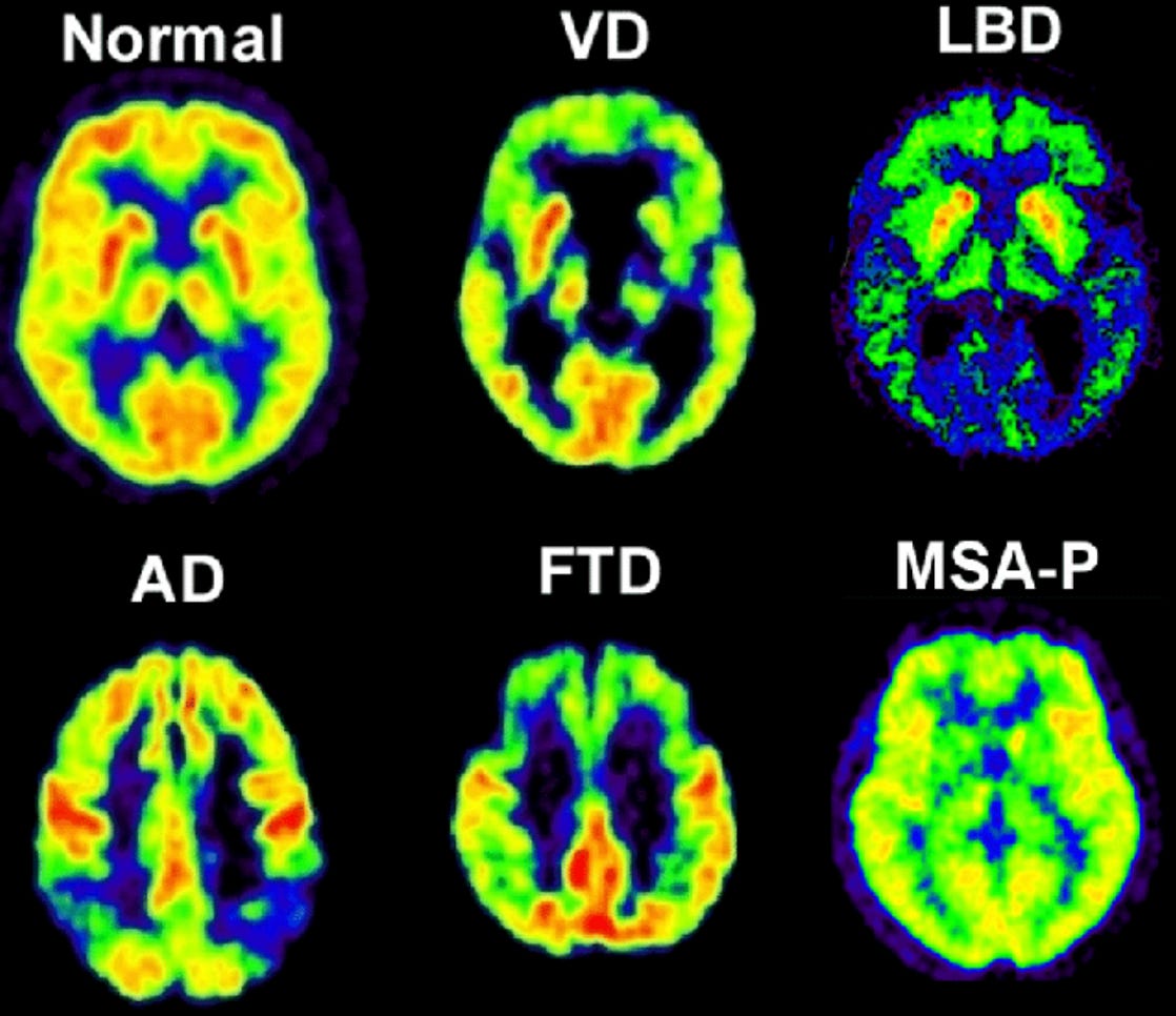 https://www.researchgate.net/figure/Typical-metabolic-patterns-for-different-types-of-dementia-compared-to-normal-controls_fig1_309655472