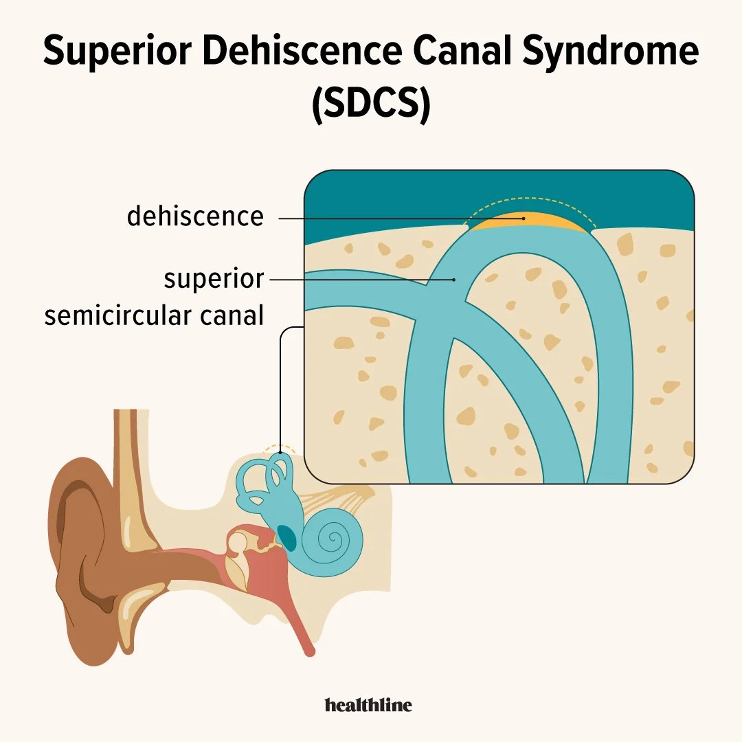 Superior Dehiscence Canal Syndrome: Symptoms, Causes, and Treatment Superior Dehiscence Canal Syndrome: Symptoms, Causes, and Treatment