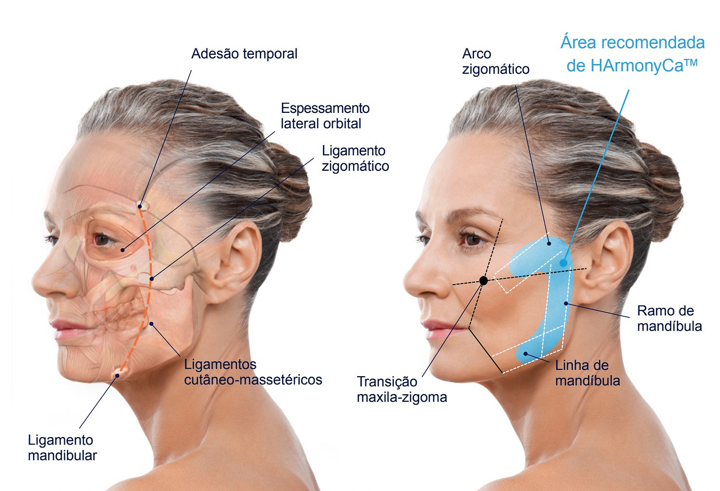 HarmonyCA, bioestimuladores, hidroxiapatita de cálcio HarmonyCA, bioestimuladores, hidroxiapatita de cálcio