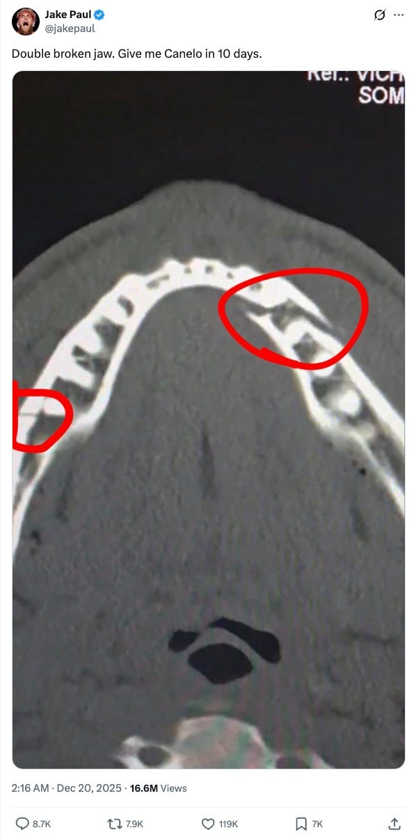 Jake Paul: Double broken jaw. Give me Canelo in 10 days.