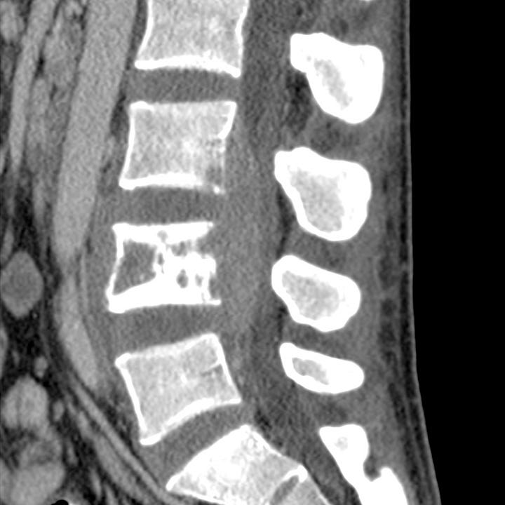 Vertebral osteomyelitis/discitis - by Alexander Baxter