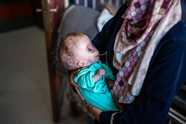Months old baby Ayyad, with abnormally large head, lost his sight due to fluid accumulation in his brain receives treatment at Aqsa Hospital amid...
