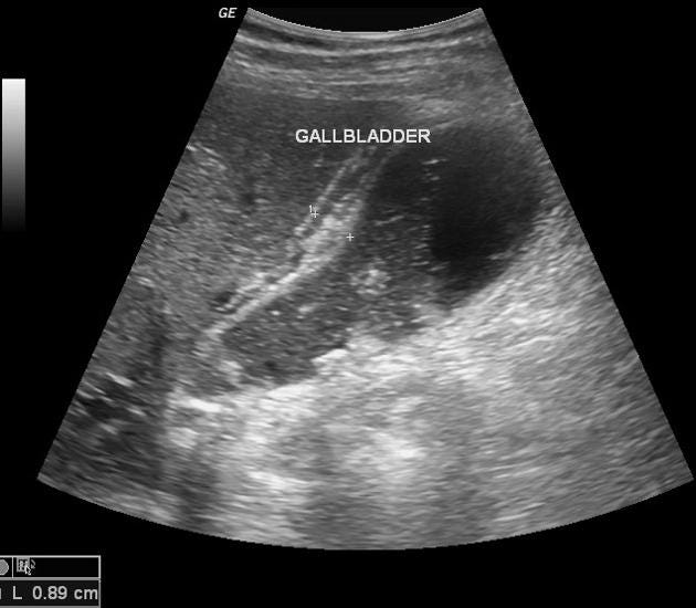 Acute cholecystitis | Radiology Reference Article | Radiopaedia.org