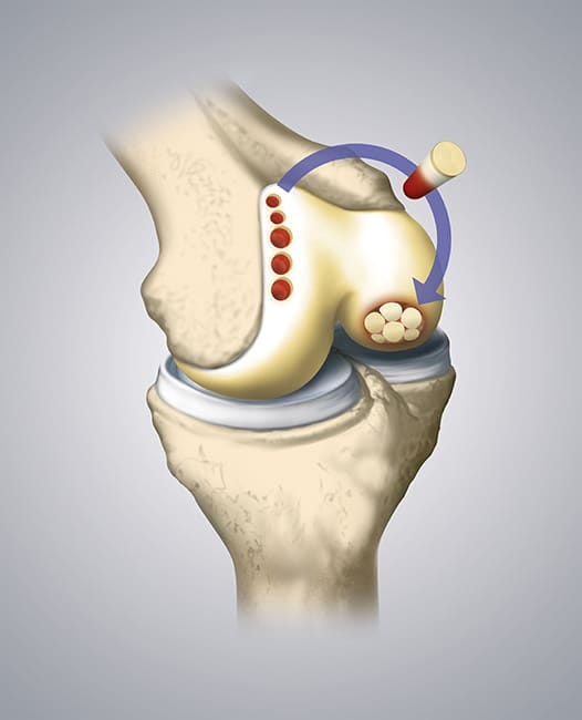 Knee cartilage damage OATS procedure