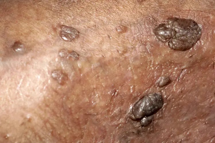 HPV Symptoms & Tests in Women & Men HPV Symptoms & Tests in Women & Men