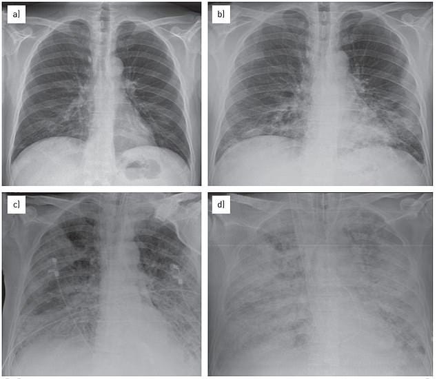The above image pictures the lungs during 'white lung syndrome' or acute respiratory distress syndrome, which is diagnosed via the white spots or opaque areas appearing in the lungs. The above patient was a 57-year-old man in 2014 The above image pictures the lungs during 'white lung syndrome' or acute respiratory distress syndrome, which is diagnosed via the white spots or opaque areas appearing in the lungs. The above patient was a 57-year-old man in 2014