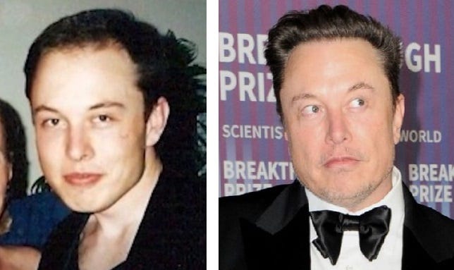 Elon Musk Hair Transplant: Everything You Need To Know