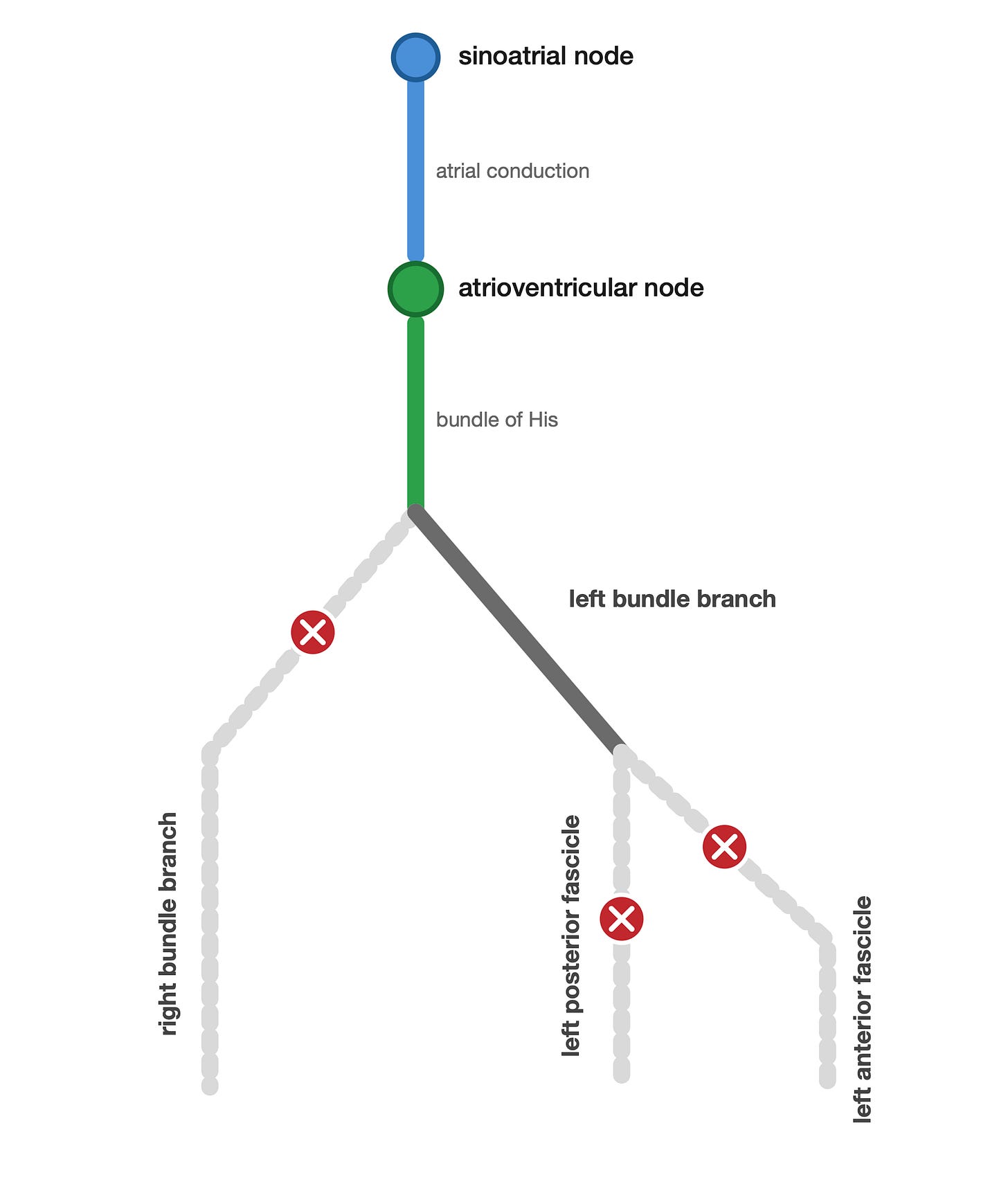 Schematic showing all three infranodal branches blocked at once: right bundle branch, left anterior fascicle, and left posterior fascicle each with a red ✕ marker