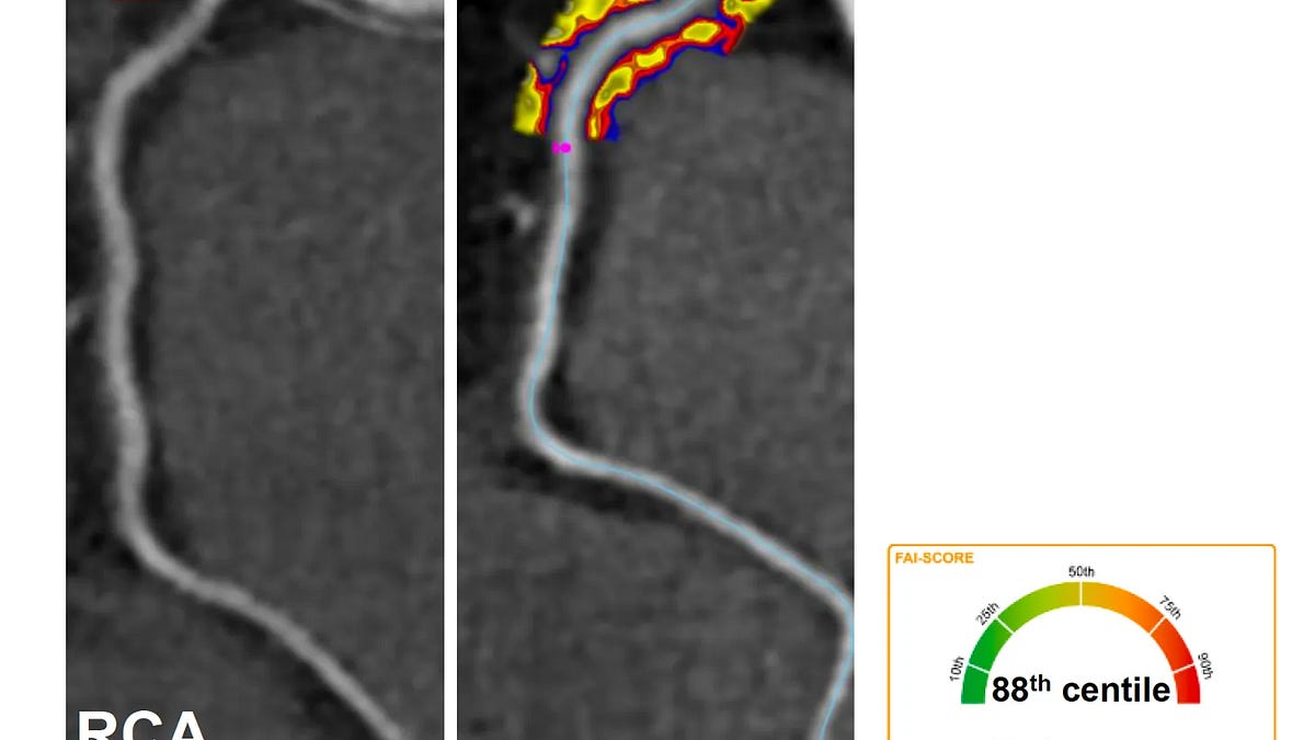 The Coronary Artery Inflammation Controversy