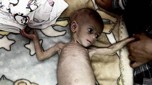 Month-old Suwar Ashur, one of hundreds of children diagnosed with malnutrition, is being treated at Nasser Hospital in Khan Yunis, Gaza on May 1,...