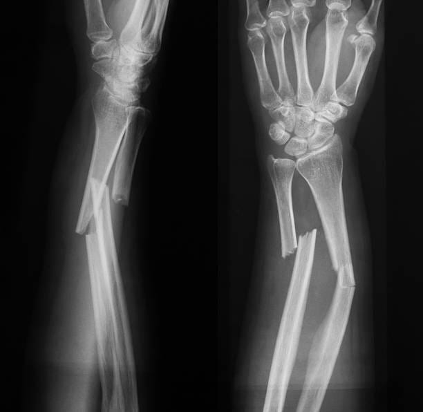 32,539 Broken Bone Stock Photos, Pictures & Royalty-Free Images - iStock