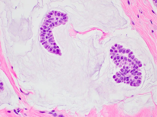 Bland epithelial cell clusters Bland epithelial cell clusters