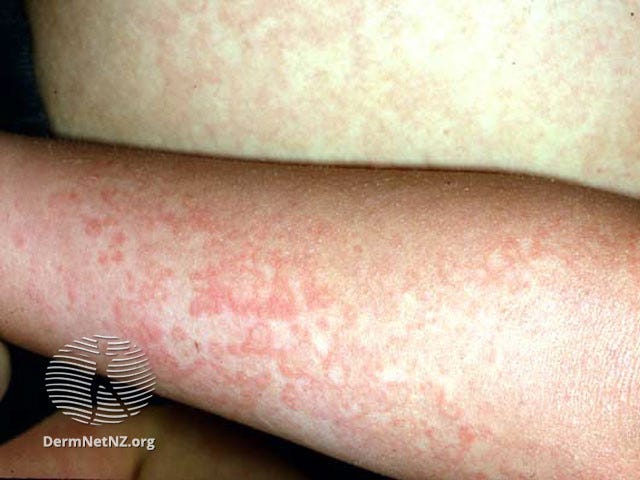 Fifth disease