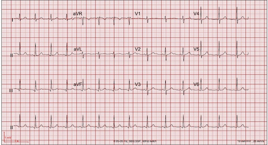 Why Routine Heart Tests and Repeat CAC Scans Are Usually Unnecessary